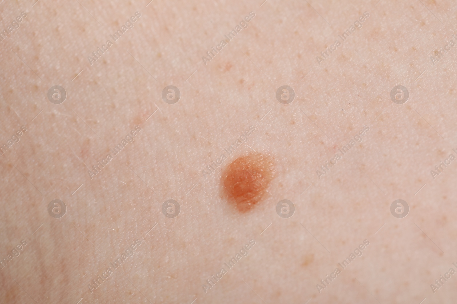 Woman with mole on her body, closeup Photo of Woman with mole on her body, closeup