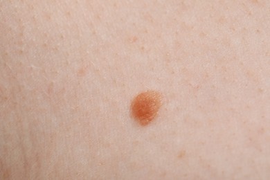 Photo of Woman with mole on her body, closeup