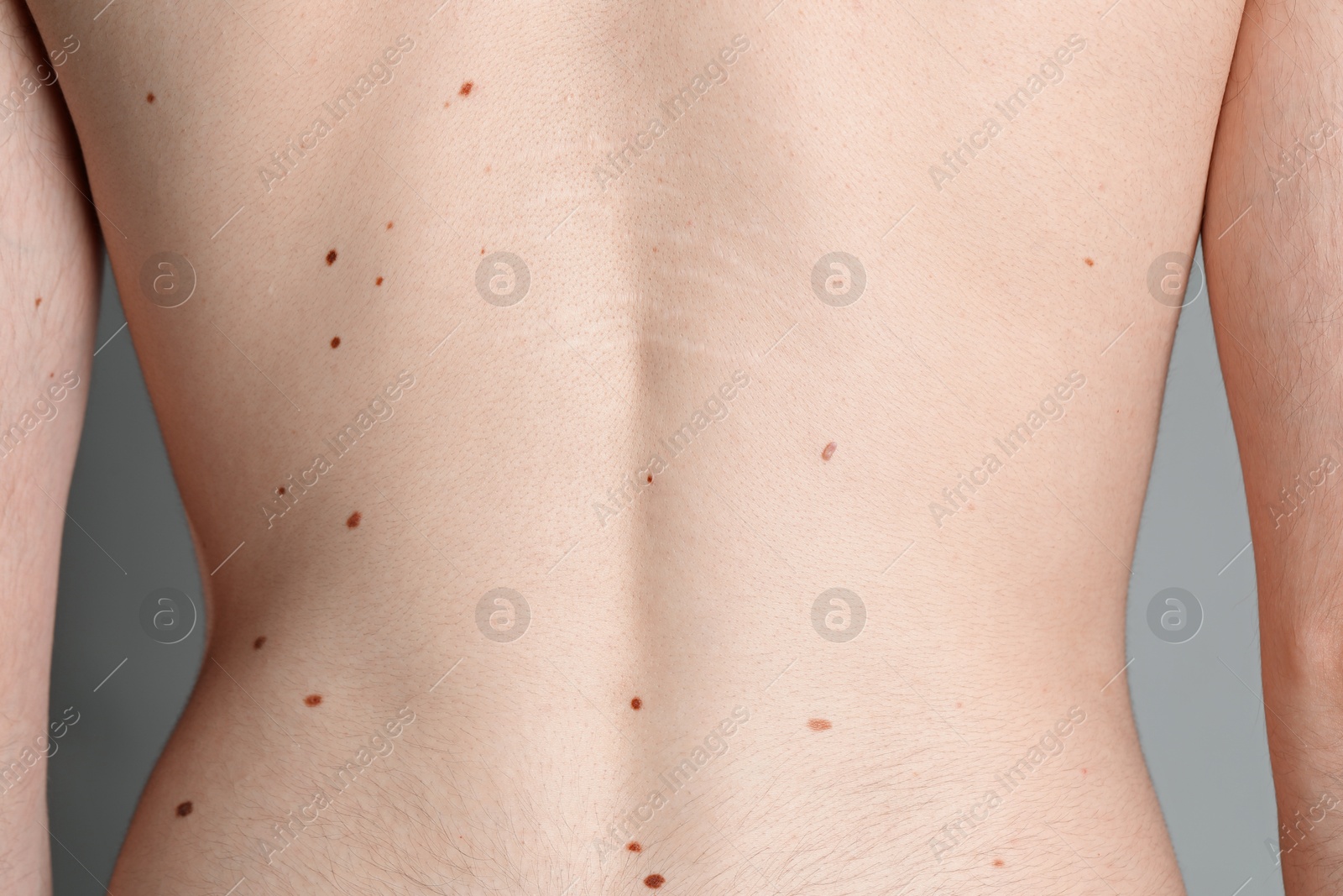 Man with moles on his body against grey background, closeup Photo of Man with moles on his body against grey background, closeup