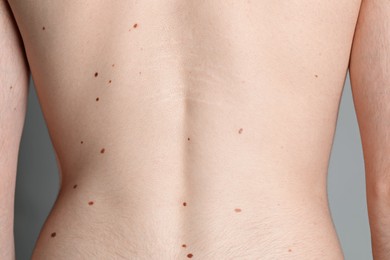 Photo of Man with moles on his body against grey background, closeup