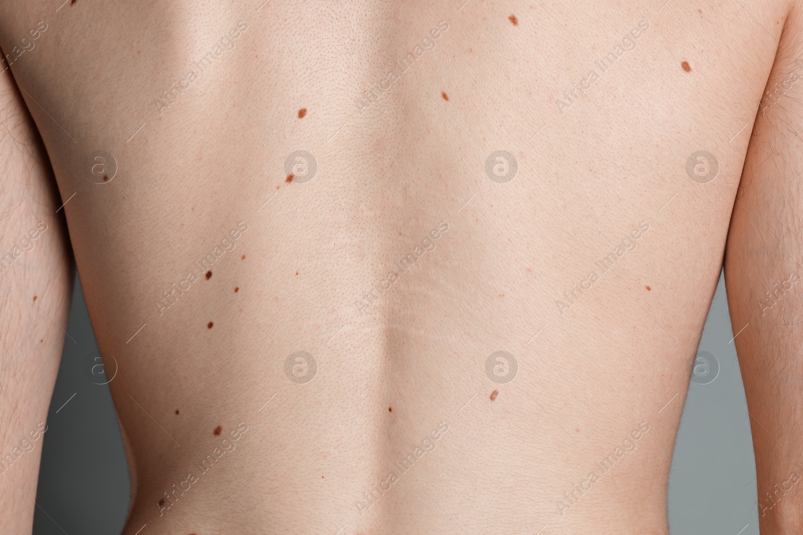 Man with moles on his body against grey background, closeup Photo of Man with moles on his body against grey background, closeup
