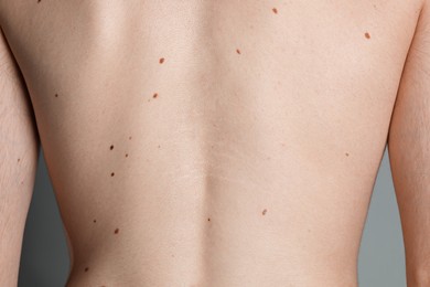 Photo of Man with moles on his body against grey background, closeup
