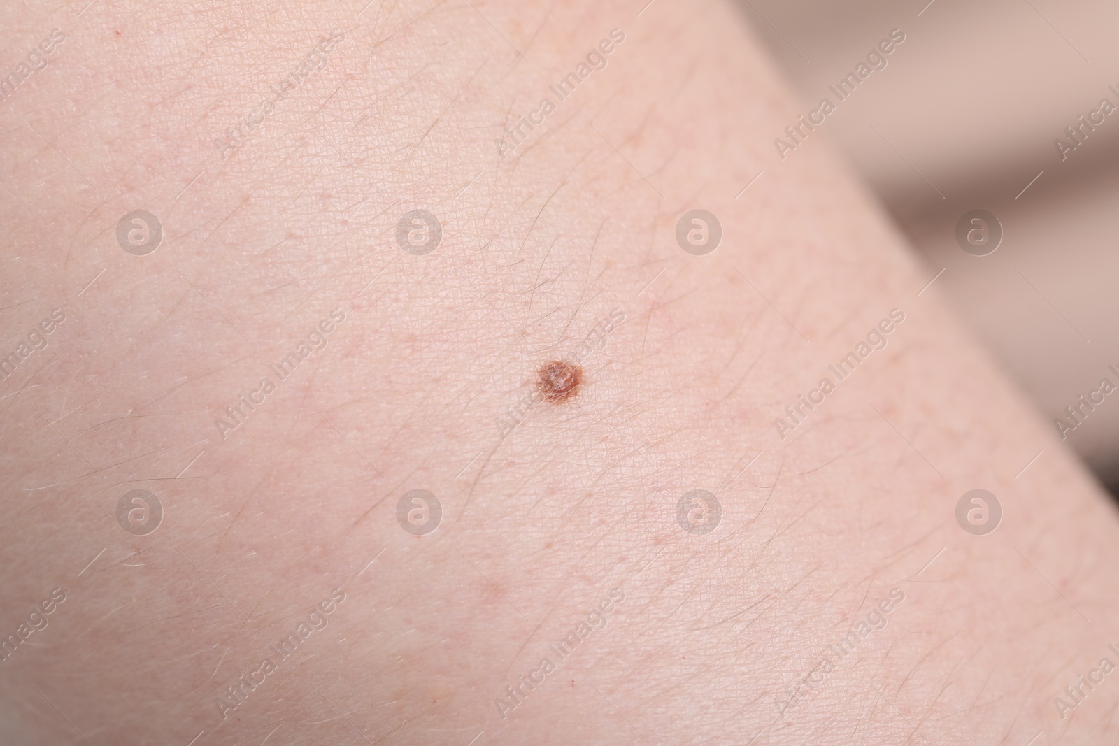 Woman with mole on her skin, macro view Photo of Woman with mole on her skin, macro view