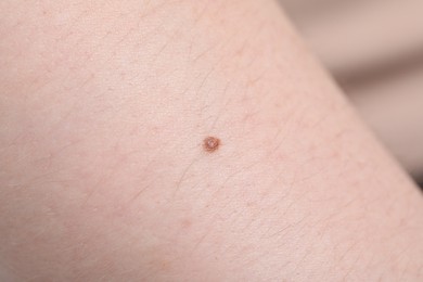 Photo of Woman with mole on her skin, macro view