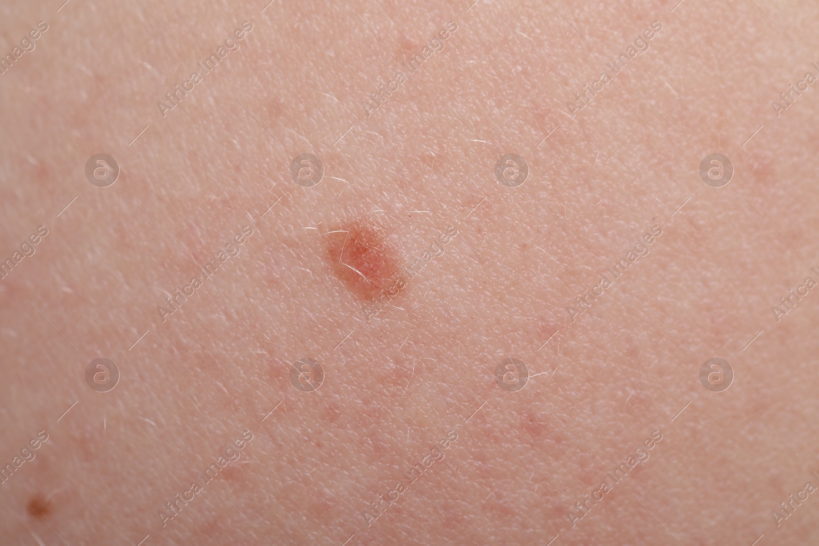 Woman with moles on her skin, macro view Photo of Woman with moles on her skin, macro view