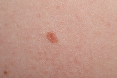Photo of Woman with moles on her skin, macro view