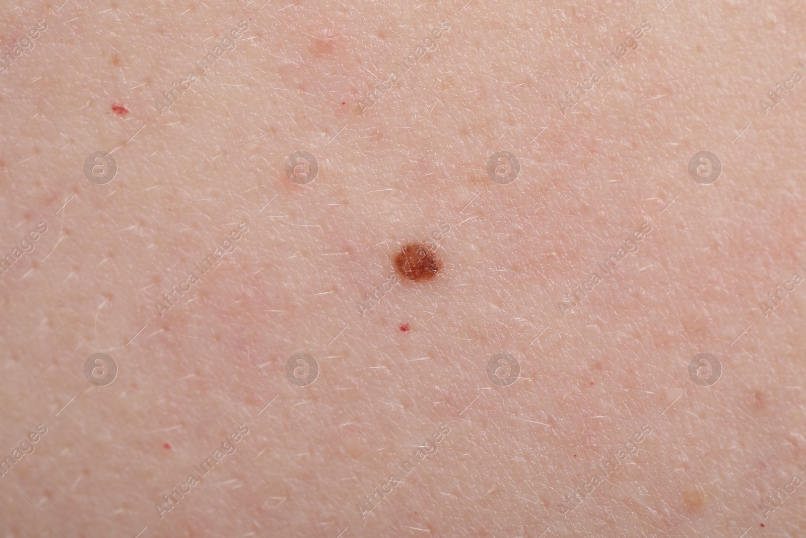 Woman with mole on her skin, macro view Photo of Woman with mole on her skin, macro view