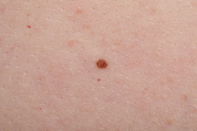 Photo of Woman with mole on her skin, macro view