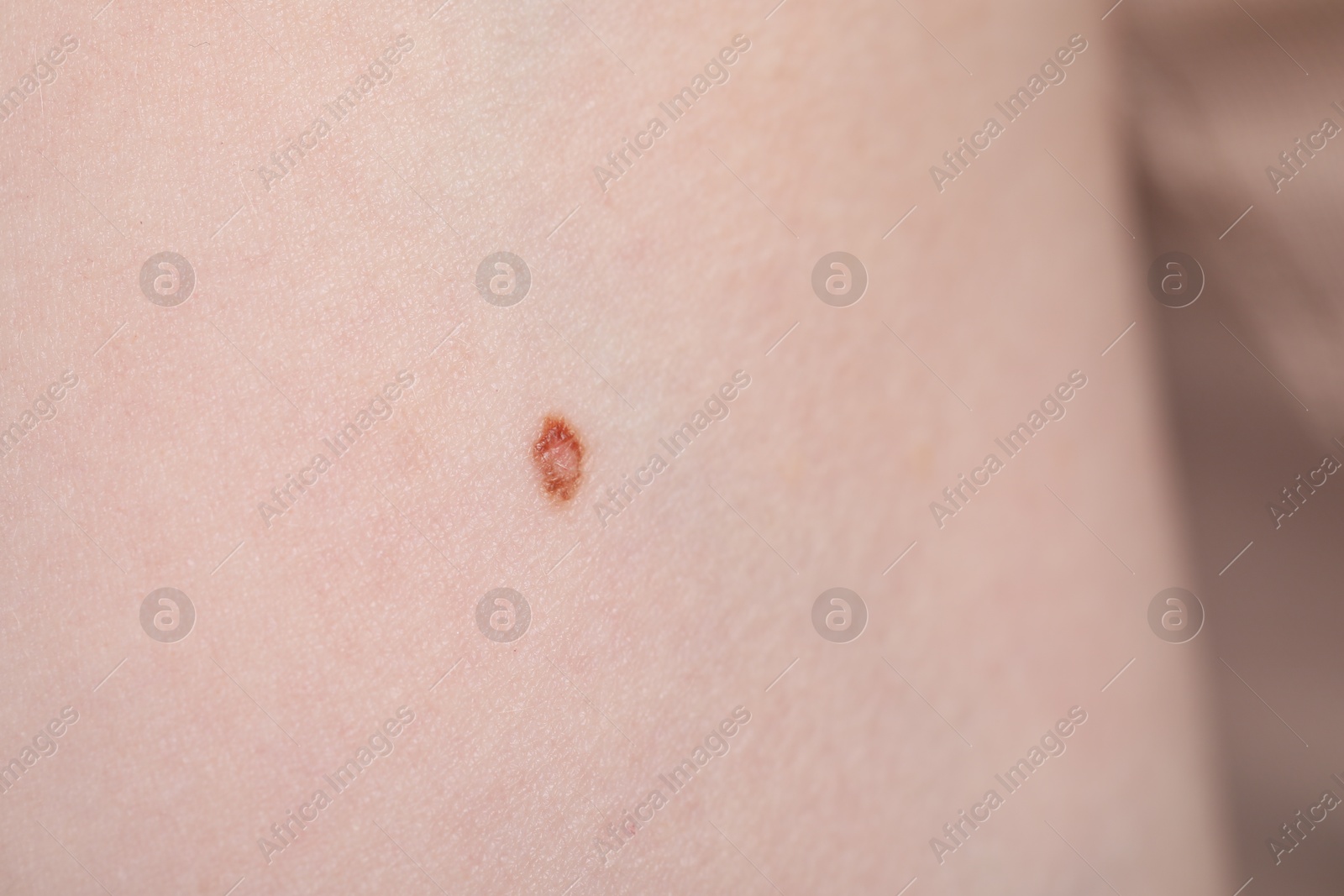 Woman with mole on her skin, macro view Photo of Woman with mole on her skin, macro view