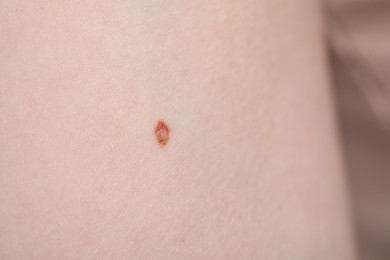 Photo of Woman with mole on her skin, macro view