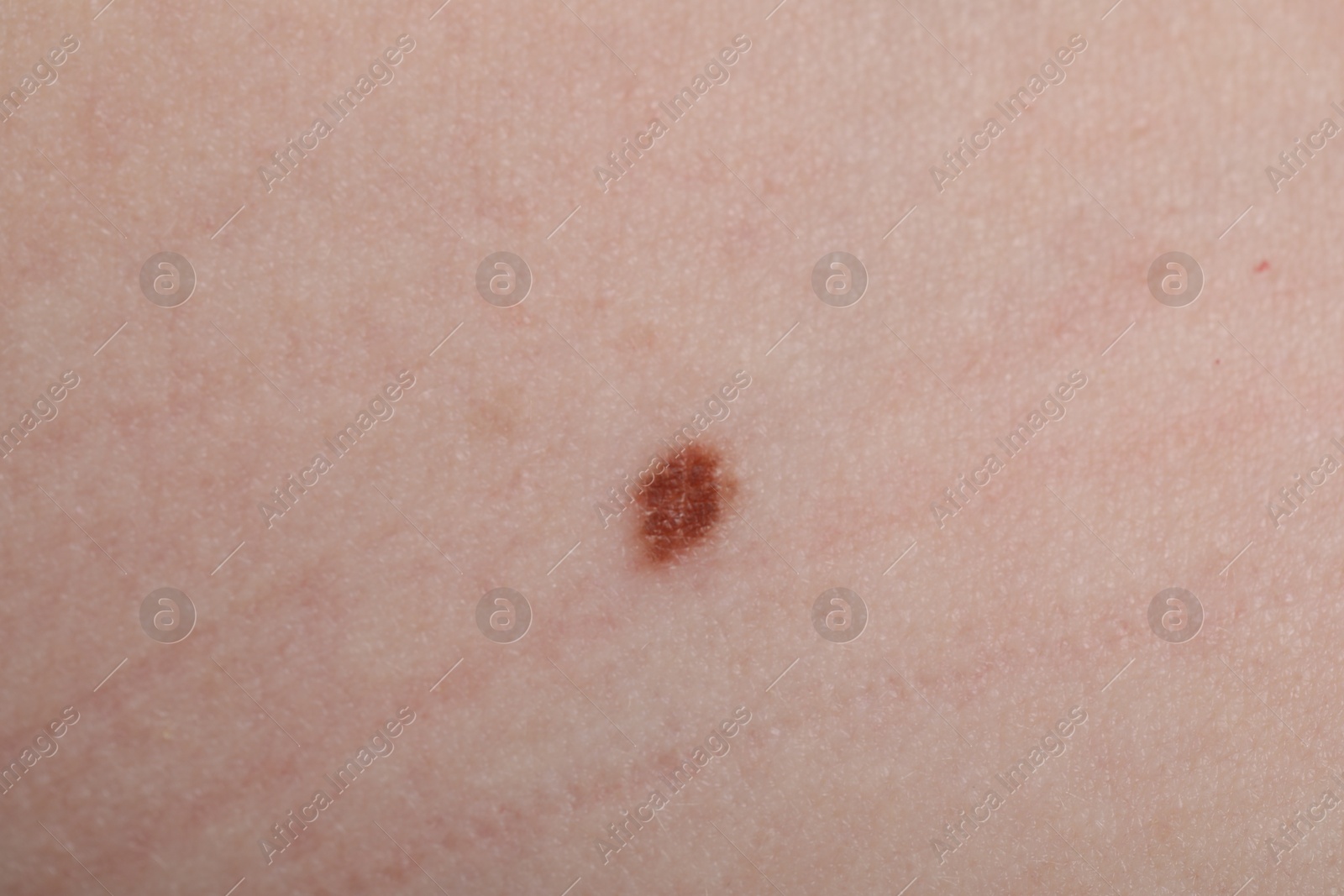 Woman with mole on her skin, macro view Photo of Woman with mole on her skin, macro view