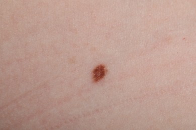 Photo of Woman with mole on her skin, macro view