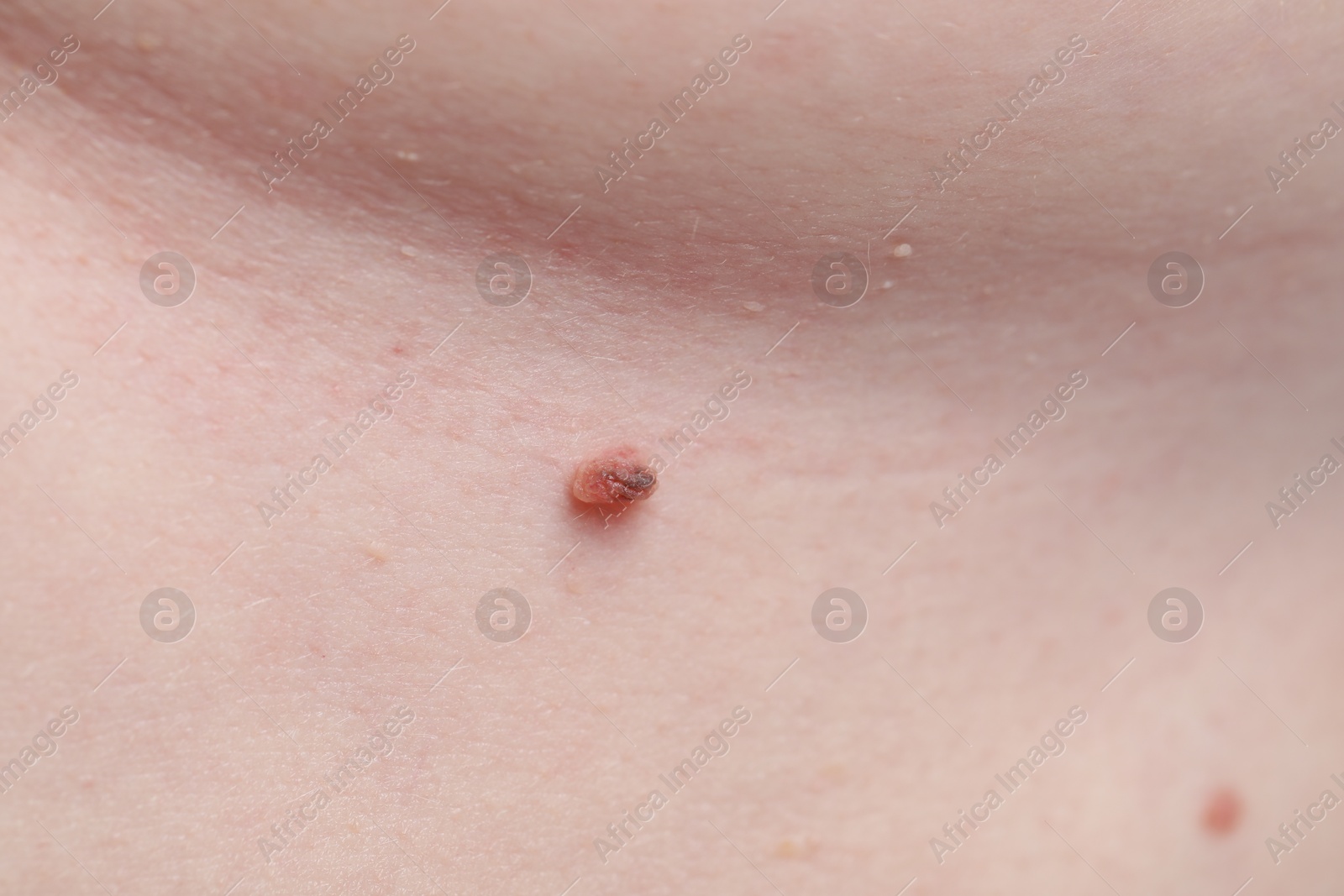 Woman with mole on her skin, macro view Photo of Woman with mole on her skin, macro view