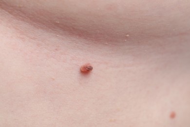 Photo of Woman with mole on her skin, macro view