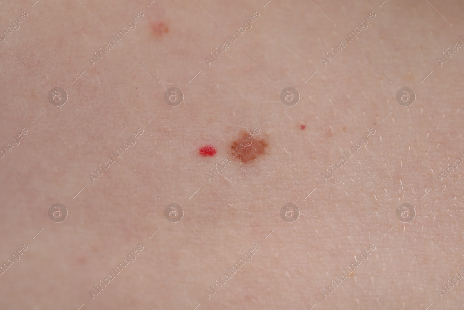 Woman with moles on her skin, macro view Photo of Woman with moles on her skin, macro view
