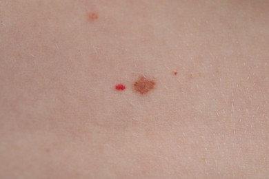 Photo of Woman with moles on her skin, macro view