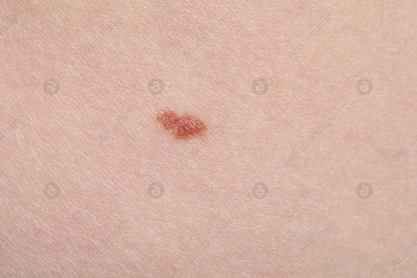Woman with mole on her skin, macro view Photo of Woman with mole on her skin, macro view