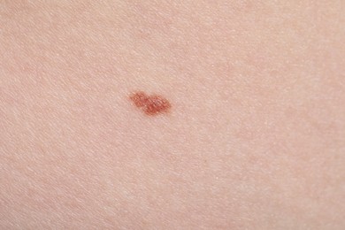 Photo of Woman with mole on her skin, macro view