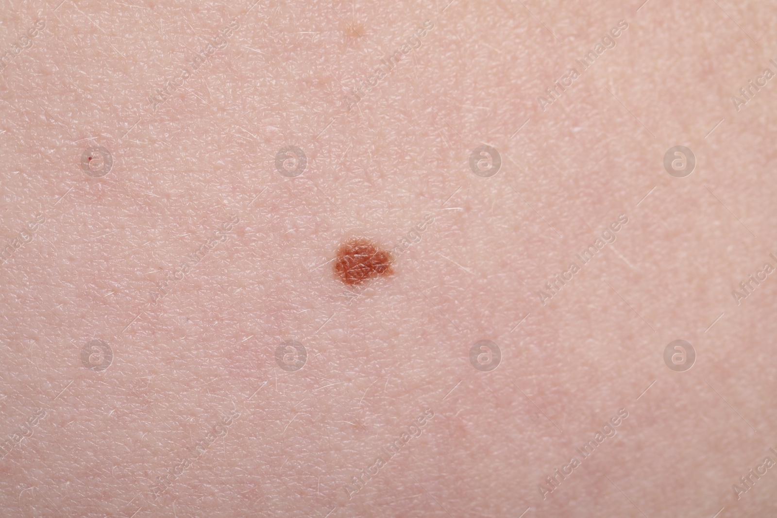Woman with mole on her skin, macro view Photo of Woman with mole on her skin, macro view
