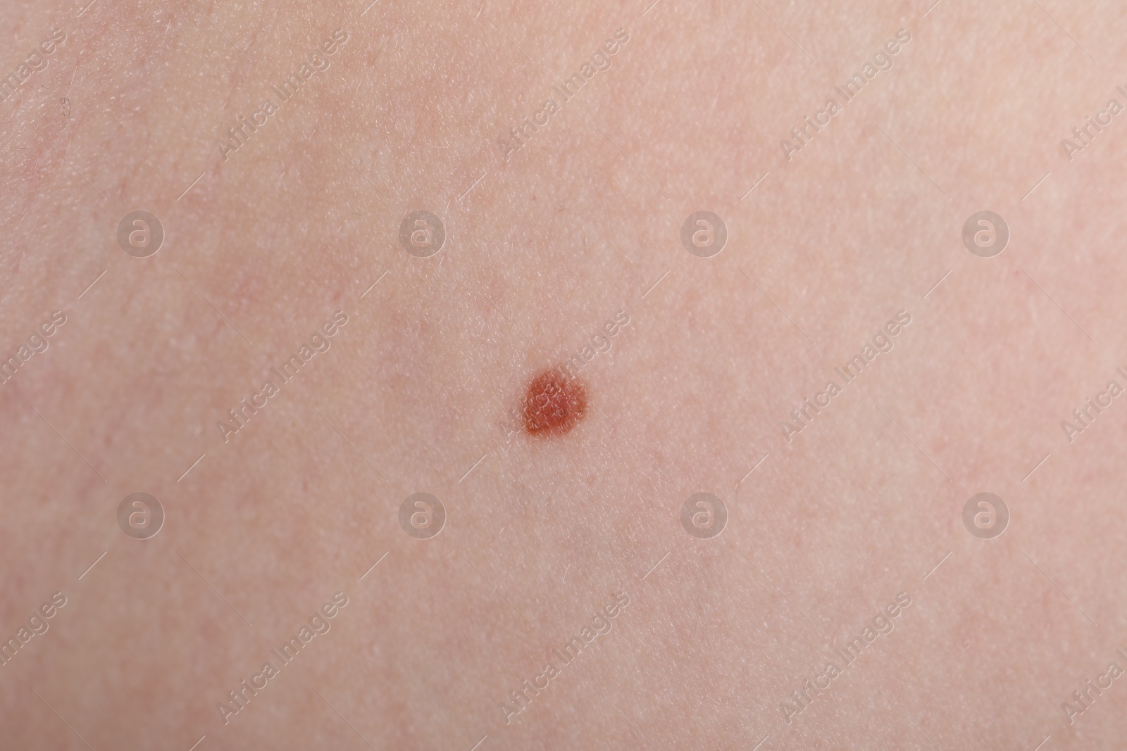 Woman with mole on her skin, macro view Photo of Woman with mole on her skin, macro view
