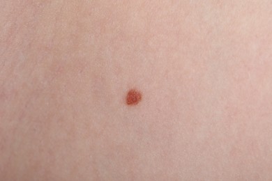 Photo of Woman with mole on her skin, macro view