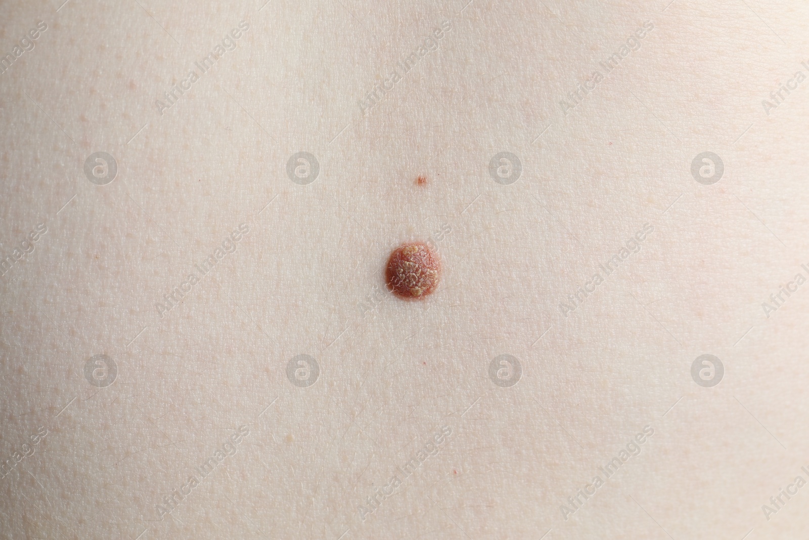Woman with mole on her skin, macro view Photo of Woman with mole on her skin, macro view