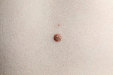Photo of Woman with mole on her skin, macro view