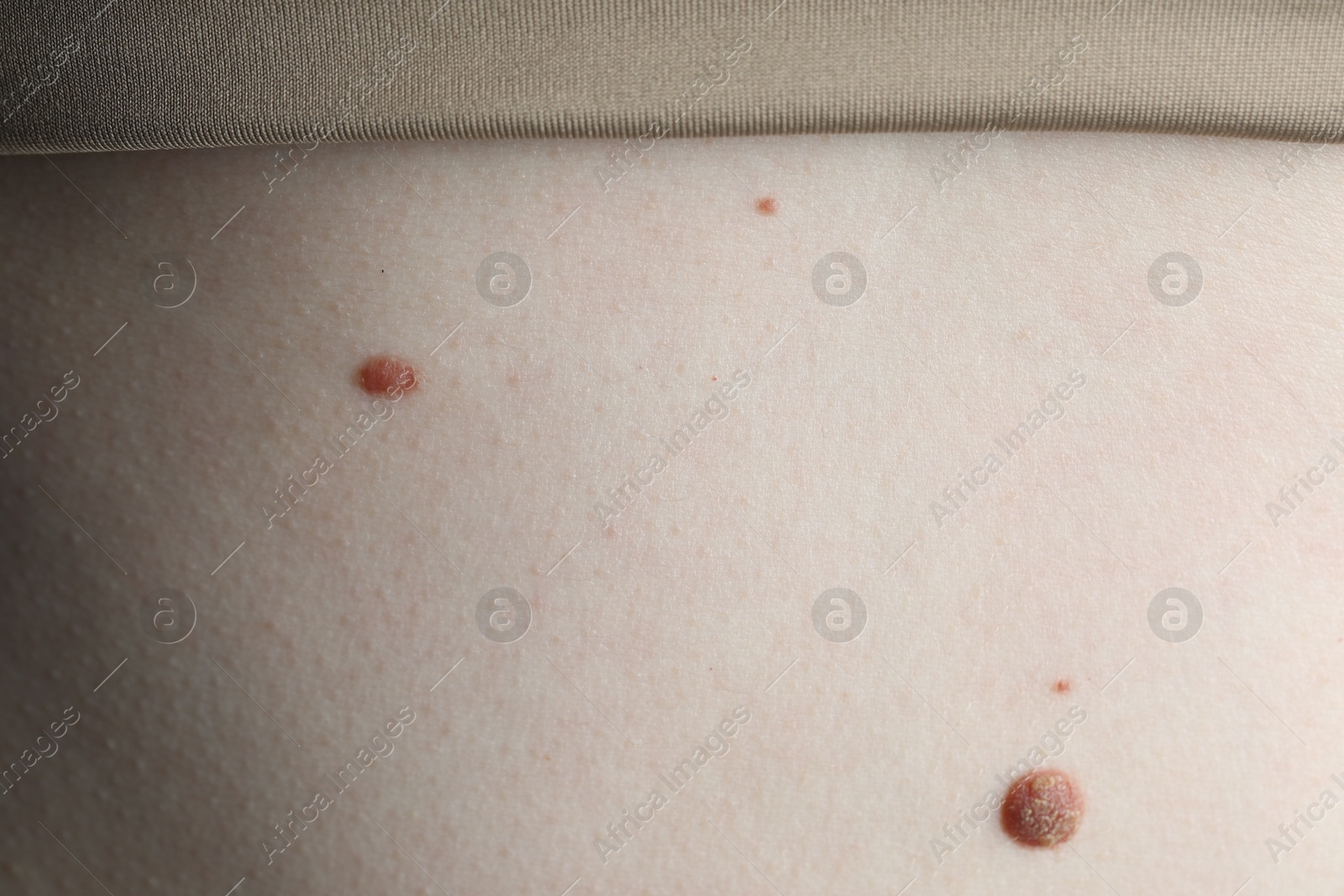 Woman with moles on her skin, macro view Photo of Woman with moles on her skin, macro view