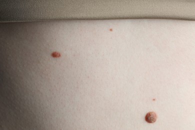 Photo of Woman with moles on her skin, macro view