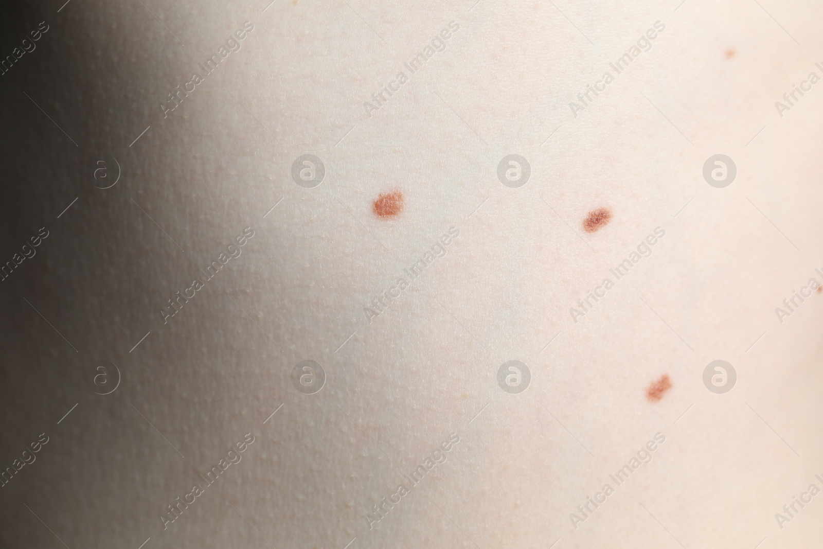 Woman with moles on her skin, macro view Photo of Woman with moles on her skin, macro view