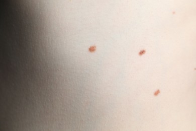 Photo of Woman with moles on her skin, macro view