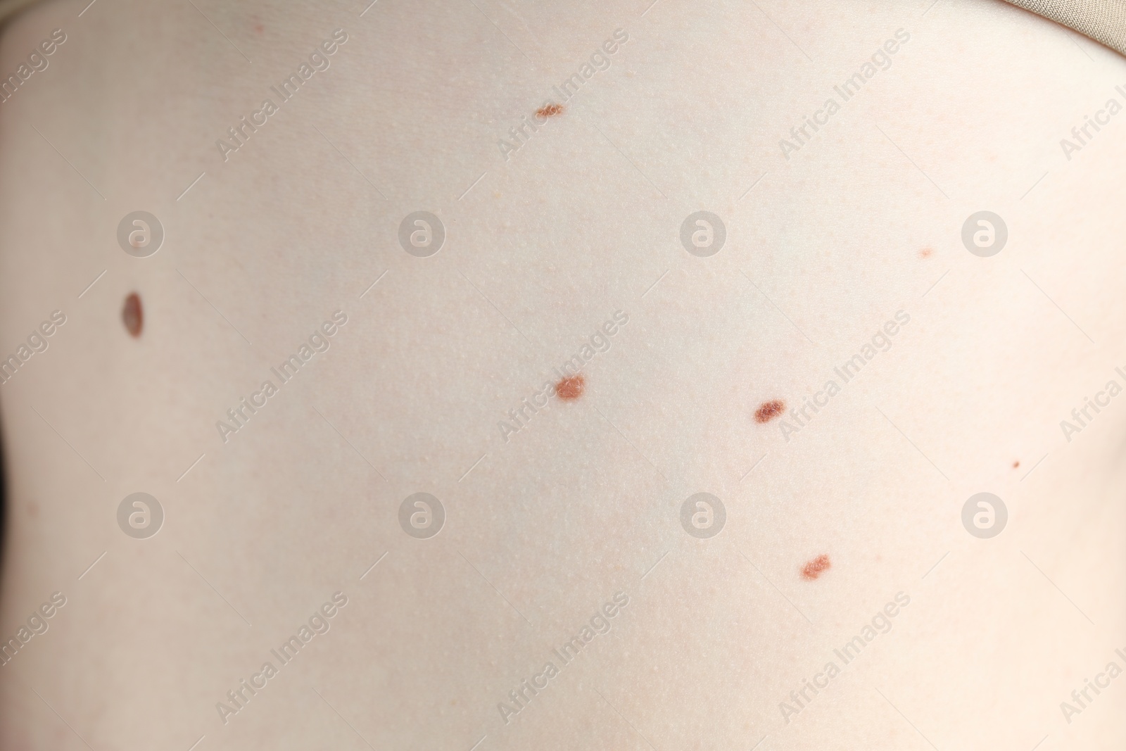 Woman with moles on her skin, macro view Photo of Woman with moles on her skin, macro view