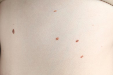 Photo of Woman with moles on her skin, macro view