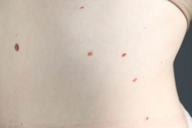 Photo of Woman with moles on her skin, macro view