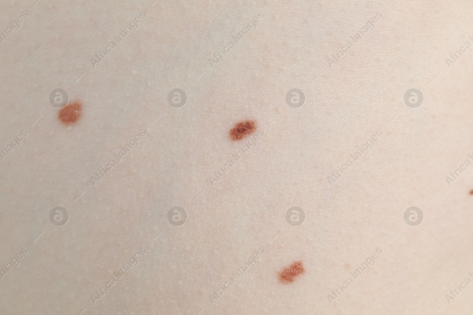 Woman with moles on her skin, macro view Photo of Woman with moles on her skin, macro view
