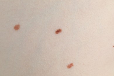 Photo of Woman with moles on her skin, macro view