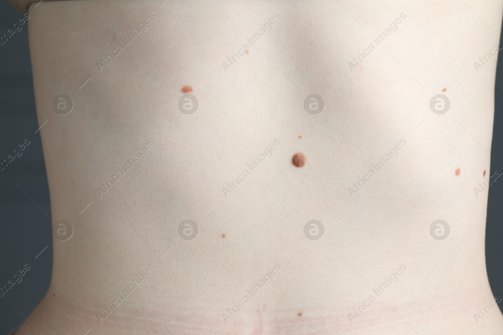 Woman with moles on her skin, macro view Photo of Woman with moles on her skin, macro view