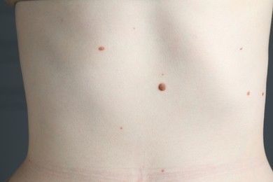 Photo of Woman with moles on her skin, macro view