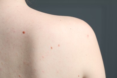 Photo of Woman with moles on her skin against grey background, macro view