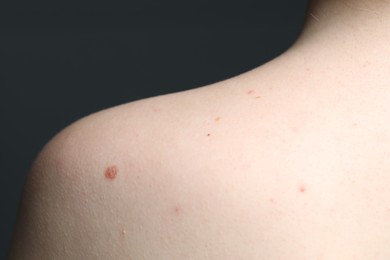 Photo of Woman with moles on her skin against grey background, macro view