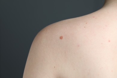 Photo of Woman with moles on her skin against grey background, macro view