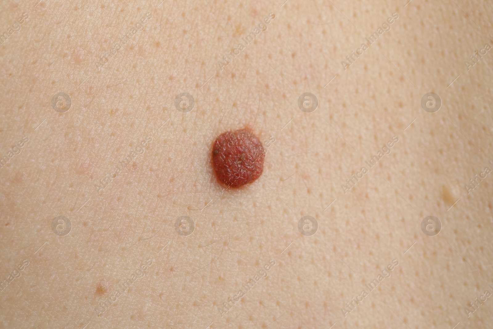Woman with mole on her skin, macro view Photo of Woman with mole on her skin, macro view