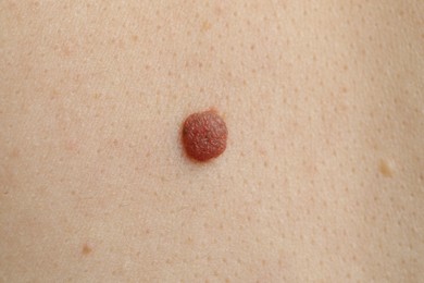 Photo of Woman with mole on her skin, macro view