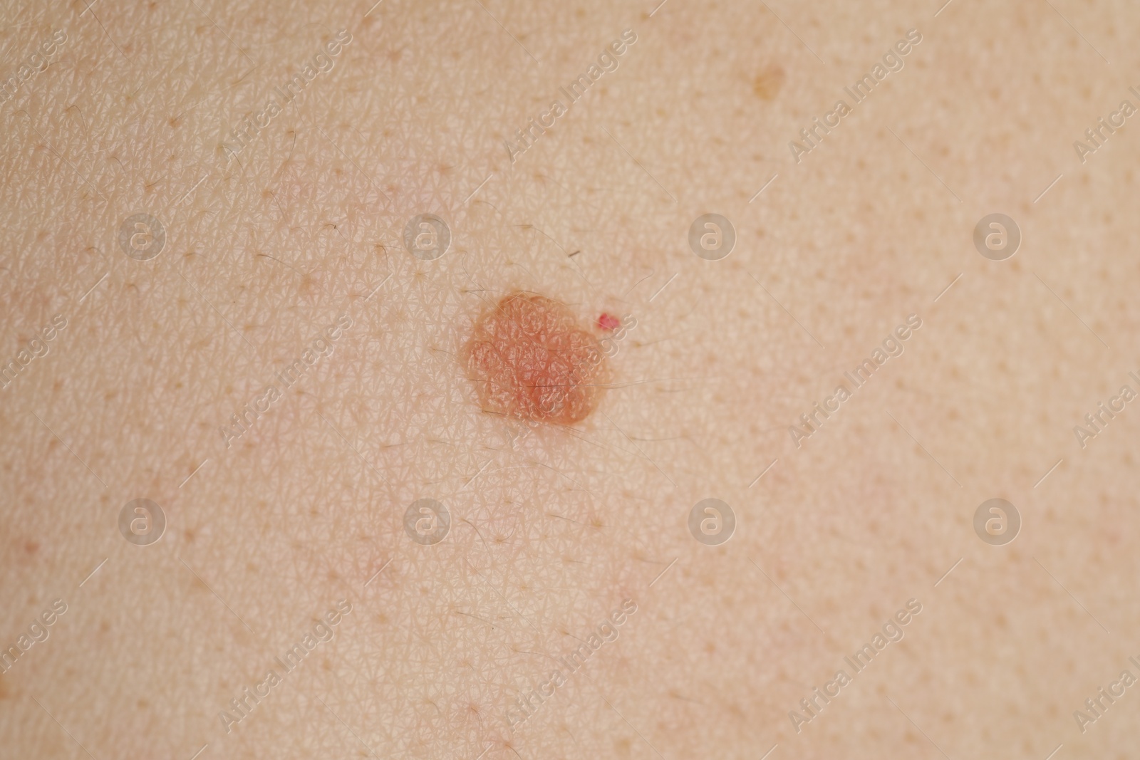 Woman with mole on her skin, macro view Photo of Woman with mole on her skin, macro view