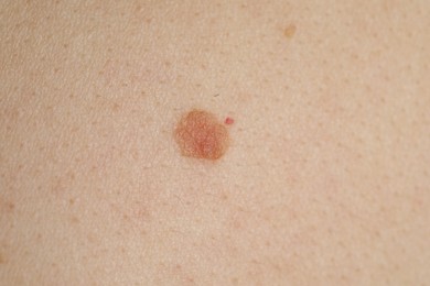 Photo of Woman with mole on her skin, macro view