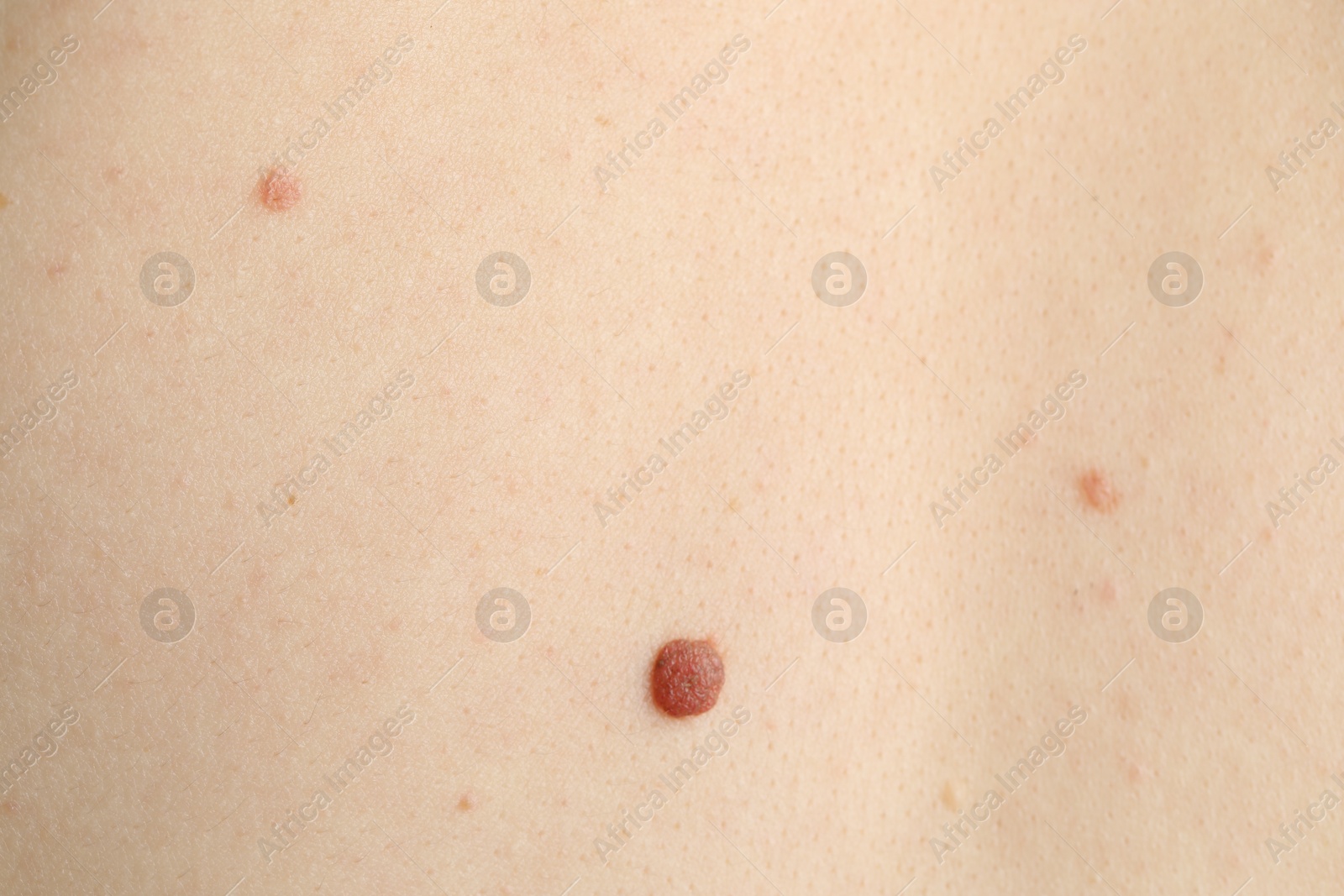 Woman with moles on her skin, macro view Photo of Woman with moles on her skin, macro view