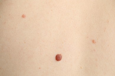 Photo of Woman with moles on her skin, macro view