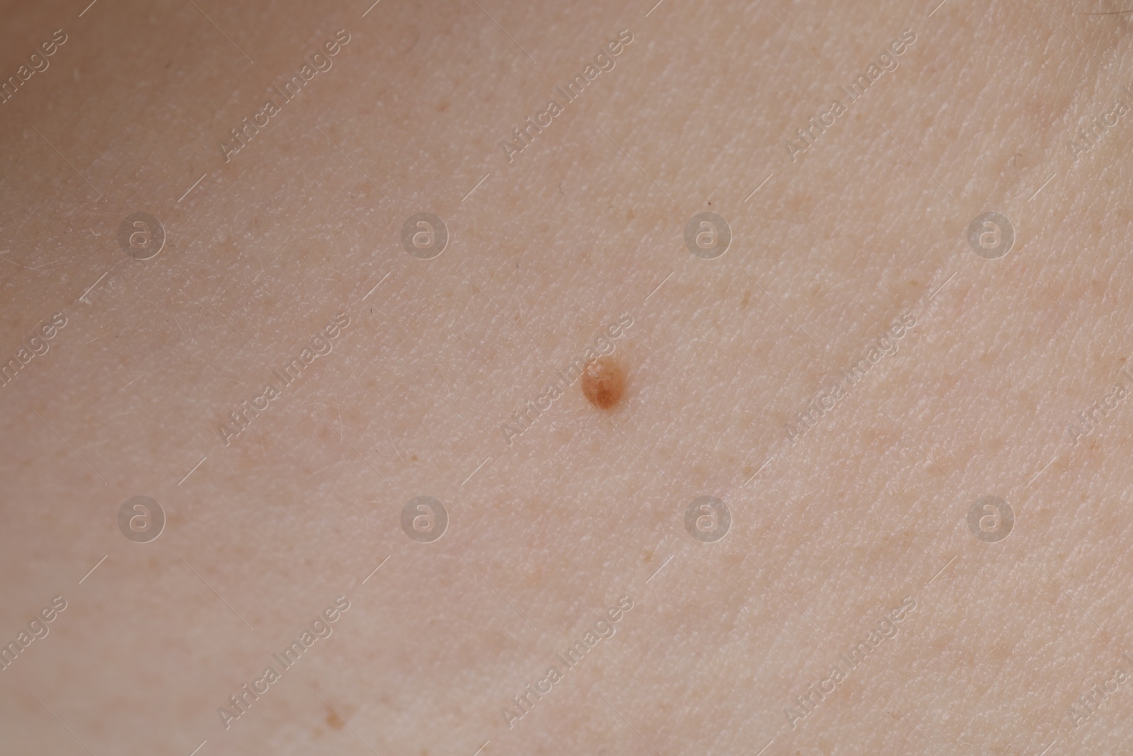 Woman with mole on her skin, macro view Photo of Woman with mole on her skin, macro view