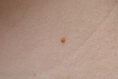 Photo of Woman with mole on her skin, macro view