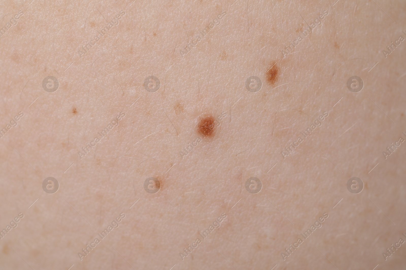 Woman with moles on her skin, macro view Photo of Woman with moles on her skin, macro view